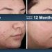 Accure Acne Announces New FDA Clearance for the Long-Term Treatment of Acne