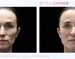 BTL’s EMFACE Surpasses 1 Million Treatments, Becoming the Fastest-Growing Non-Invasive Facial Lifting Procedure