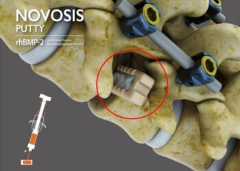 CGBIO Receives FDA IDE Approval for NOVOSIS PUTTY, Advancing Toward U.S. Market Entry