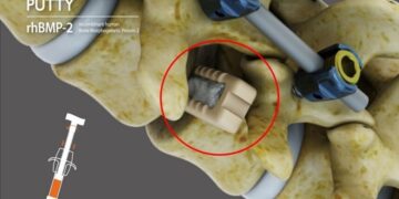 CGBIO Receives FDA IDE Approval for NOVOSIS PUTTY, Advancing Toward U.S. Market Entry