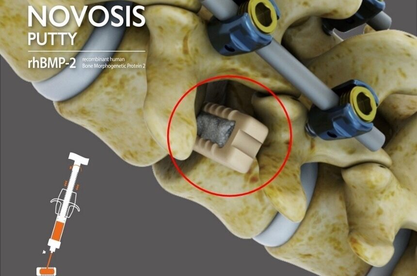 CGBIO Receives FDA IDE Approval for NOVOSIS PUTTY, Advancing Toward U.S. Market Entry