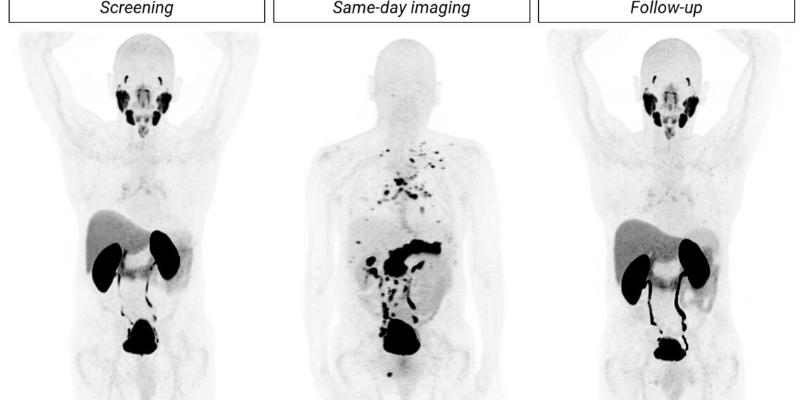 SABRE topline results: Cu-64 SAR-Bombesin is effective in detecting prostate cancer recurrence in patients with negative SOC imaging
