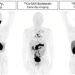 SABRE topline results: Cu-64 SAR-Bombesin is effective in detecting prostate cancer recurrence in patients with negative SOC imaging