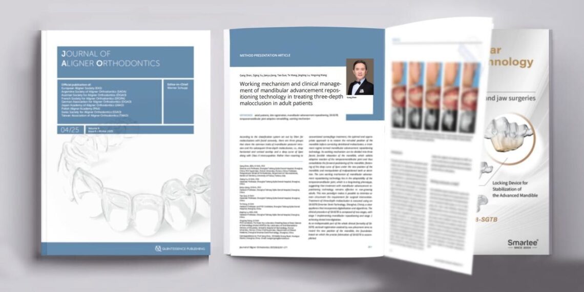 Prof. Gang Shen’s Research Paper about Mandibular Advancement Repositioning Technology in the Journal of Aligner Orthodontics