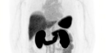 SECuRE trial to continue with no modifications to protocol following Safety Review Committee meeting