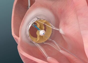 Trisol Medical Announces Positive Results from U.S. Early Feasibility Study of Its Transcatheter Tricuspid Valve Replacement System