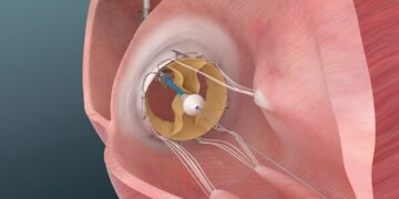 Trisol Medical Announces Positive Results from U.S. Early Feasibility Study of Its Transcatheter Tricuspid Valve Replacement System