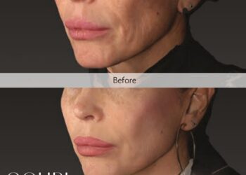 Global Aesthetic Trends Evolve Toward ‘Anti-Sagging’: The Expansion of the Structural Skin Laxity Improvement and Liquid Type PCL Collagen Stimulator Market