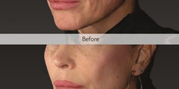Global Aesthetic Trends Evolve Toward ‘Anti-Sagging’: The Expansion of the Structural Skin Laxity Improvement and Liquid Type PCL Collagen Stimulator Market