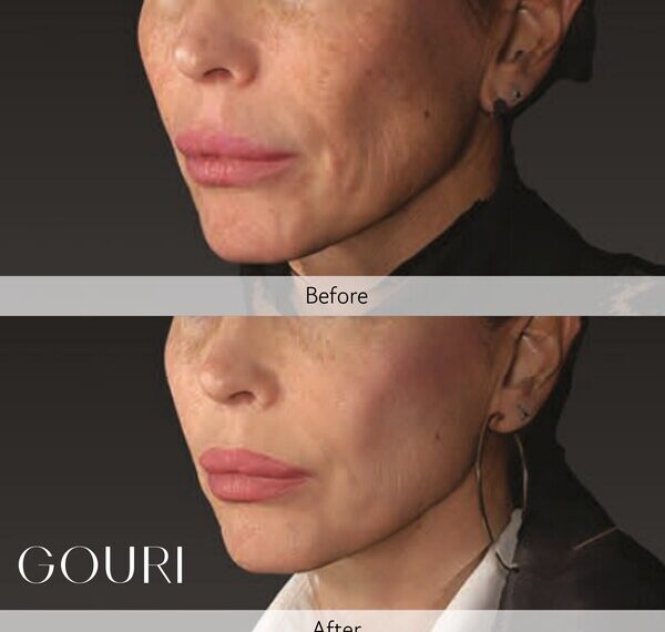 Global Aesthetic Trends Evolve Toward ‘Anti-Sagging’: The Expansion of the Structural Skin Laxity Improvement and Liquid Type PCL Collagen Stimulator Market