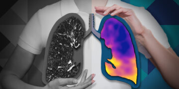 4DMedical receives CE Mark for CT:VQ™, enabling commercial launch across the European Union