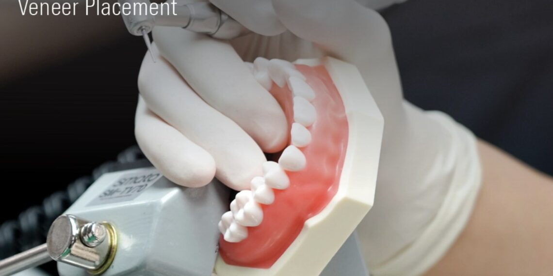 MINISH Veneers to Host U.S. CE Course in California, Expanding Biomimetic Dentistry Training to North America