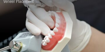 MINISH Veneers to Host U.S. CE Course in California, Expanding Biomimetic Dentistry Training to North America