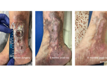 VERIGRAFT Advances First Potential Curative Treatment for CVI into Pivotal Phase II/III Trial