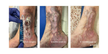 VERIGRAFT Advances First Potential Curative Treatment for CVI into Pivotal Phase II/III Trial