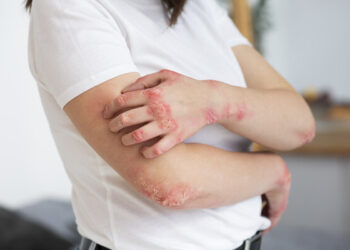 Why Chronic Eczema Can Last for Decades, and What a Recent Case Is Revealing