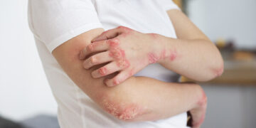Why Chronic Eczema Can Last for Decades, and What a Recent Case Is Revealing