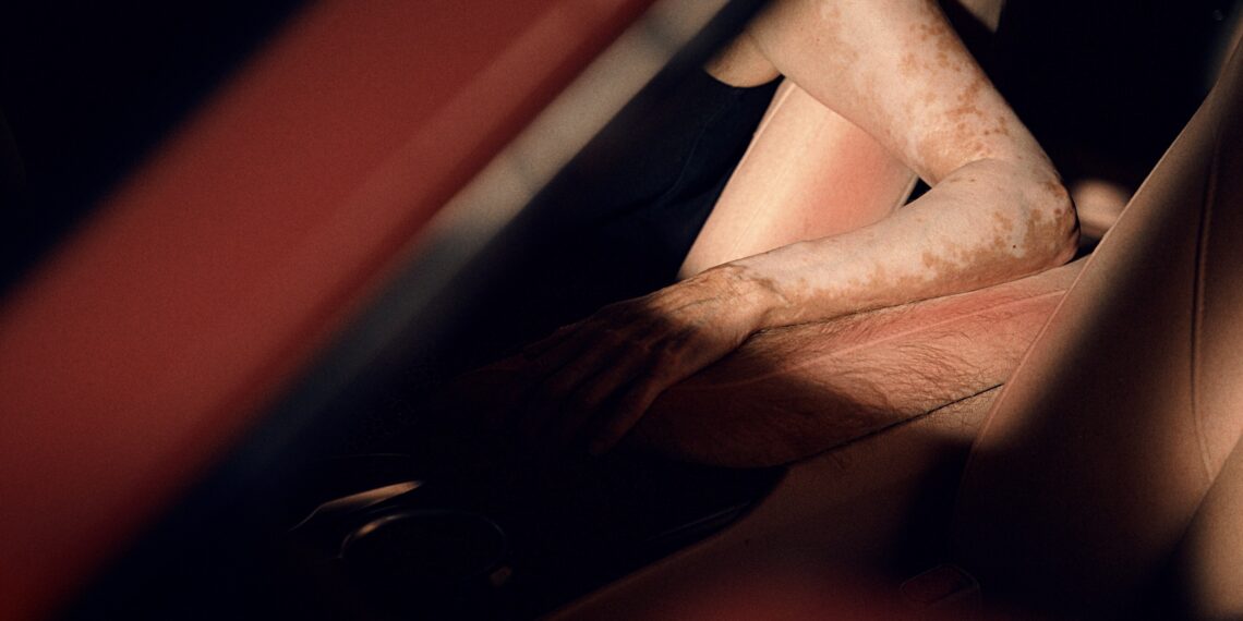 mycar Tyre & Auto creates the world’s first “Sunburnt Car”, showing driver’s sun safety “Blindspot” to UV Exposure Behind the Wheel