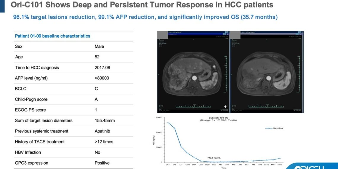 ASCO 2026 | Oricell’s GPC3 CAR-T Ori-C101 Hits 66.7% ORR in Late-Line HCC, Signaling Best-in-Class Potential