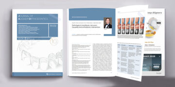 Professor Gang Shen’s Orthodontic Team Publishes Third Consecutive Paper in the Journal of Aligner Orthodontics