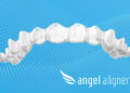 Paris Court Ruling on Discontinued Feature Will Have Minimal Impact on Angelalign Customers